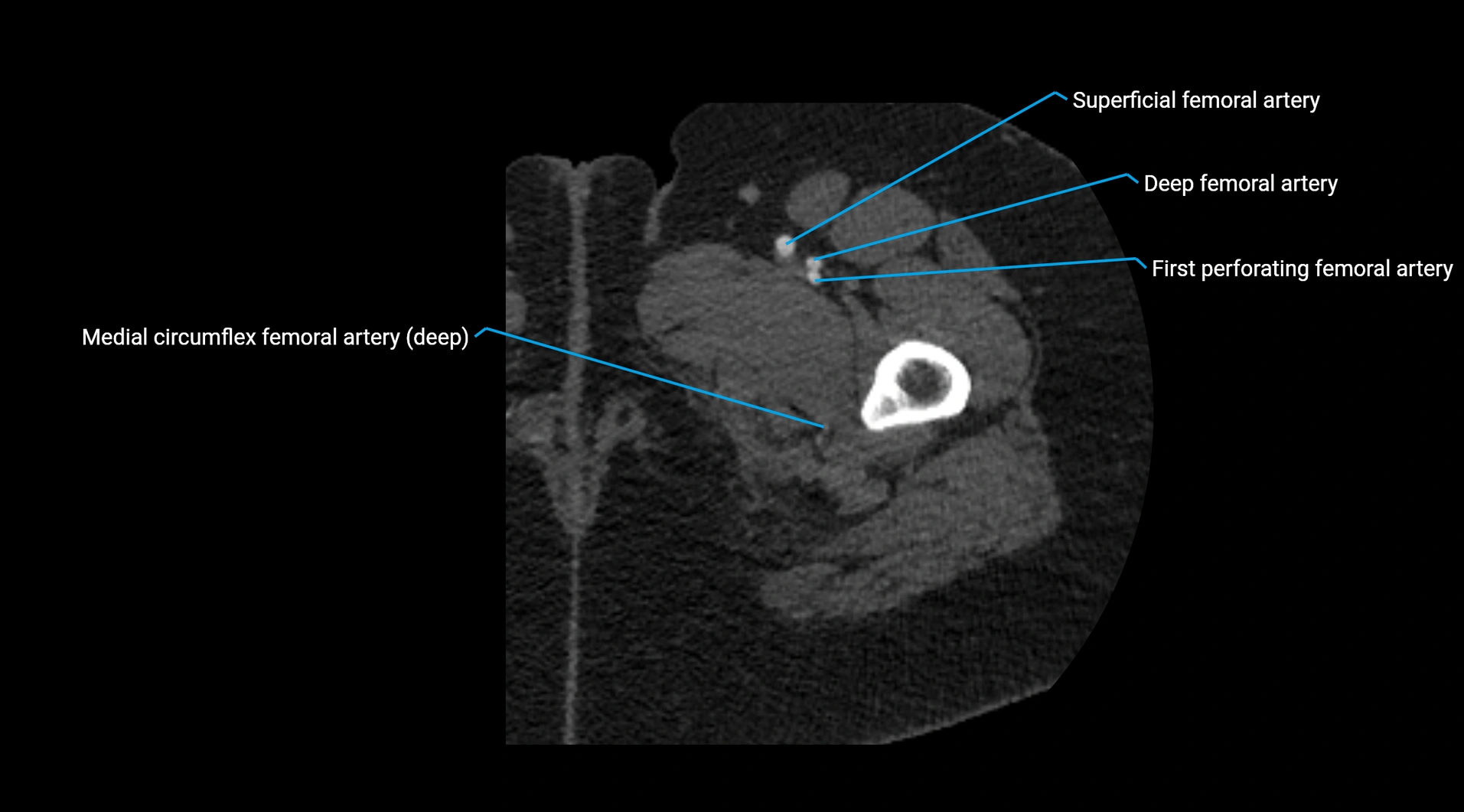 CTA lower limb cross sectional anatomy labelled image _78.webp